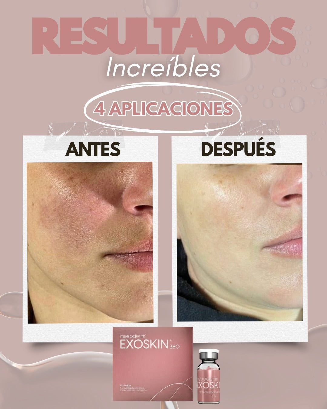 EXOSKIN 360