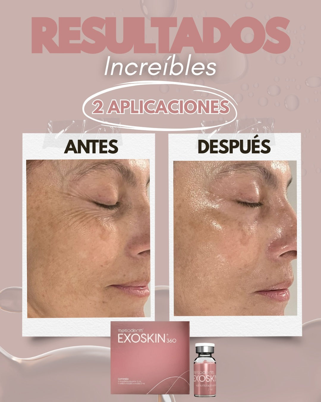 EXOSKIN 360
