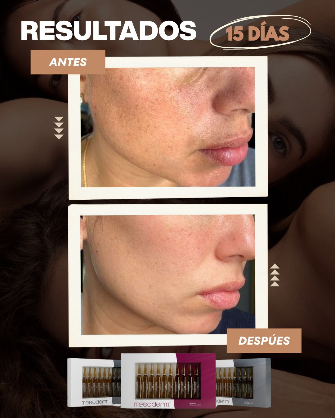 Tratamiento Facial Terapia Bioestimuladora + Antimanchas