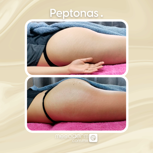 Antes